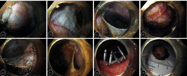Endoscopic Resection of Tailgut Cyst.