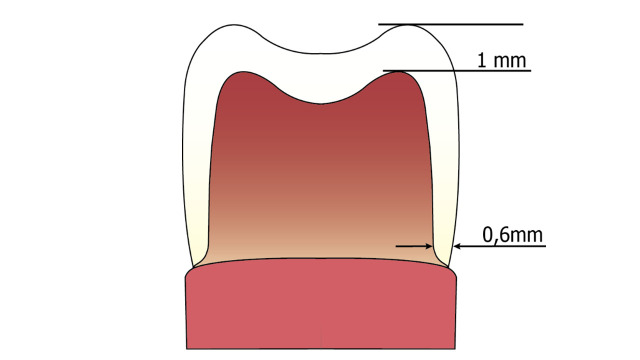Clinical Survival of Reduced-Thickness Monolithic Lithium-Disilicate Crowns: A 3-Year Randomized Controlled Trial.