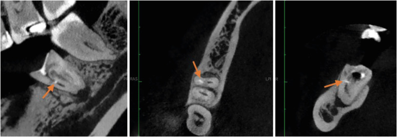 Procedural errors detected by cone beam tomography in cases with indication for retreatment: <i>in vivo</i> cross-sectional study.