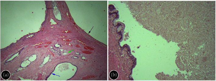 Endoscopic Resection of Tailgut Cyst.