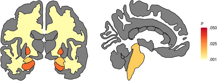 Volumetric brain reductions in adult patients with phenylketonuria and their relationship with blood phenylalanine levels.