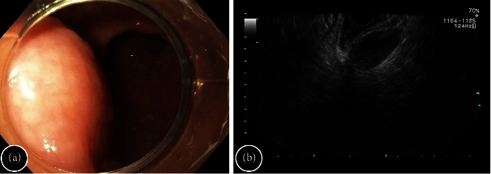 Endoscopic Resection of Tailgut Cyst.