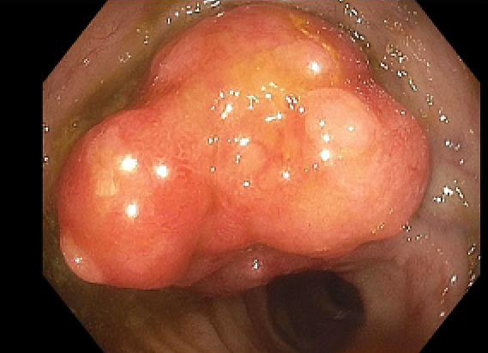 Gastrointestinal Symptom-Free Multiple Lymphomatous Polyposis: An Atypical Case Presentation of Mantle Cell Lymphoma.
