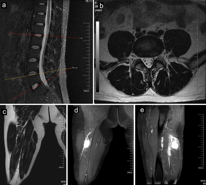 Inflammatory Myofibroblastic Tumor of the Sciatic Nerve Mimicking Lumbar Disc Herniation: A Diagnostic Challenge.