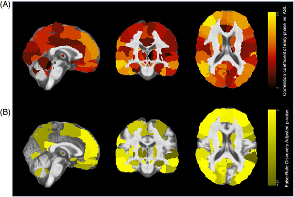 Early-phase amyloid PET reproduces metabolic signatures of cognitive decline in Parkinson's disease.