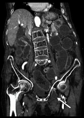The "Little-Old-Lady's Hernia", Obturator Hernia: A Case Report and Literature Review.