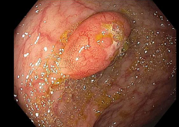 Gastrointestinal Symptom-Free Multiple Lymphomatous Polyposis: An Atypical Case Presentation of Mantle Cell Lymphoma.