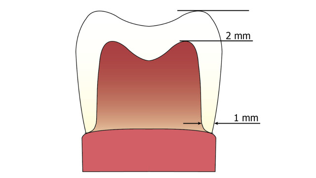 Clinical Survival of Reduced-Thickness Monolithic Lithium-Disilicate Crowns: A 3-Year Randomized Controlled Trial.