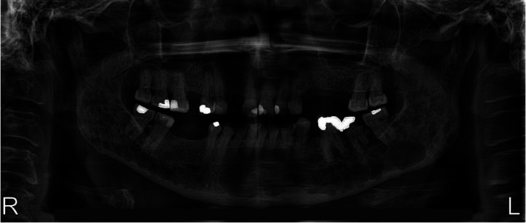 Beyond the mouth: Uncovering non-secretory multiple myeloma through oral symptoms.