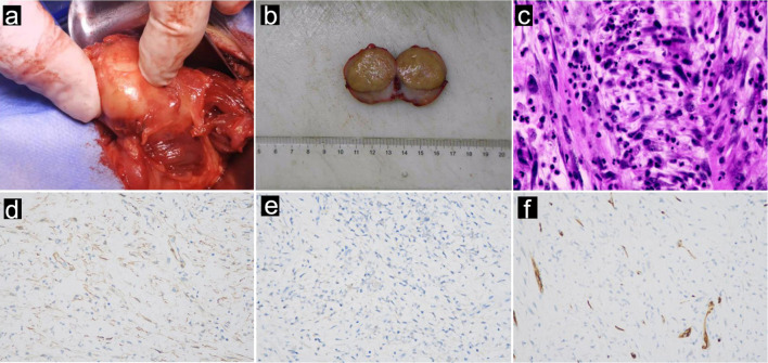 Inflammatory Myofibroblastic Tumor of the Sciatic Nerve Mimicking Lumbar Disc Herniation: A Diagnostic Challenge.