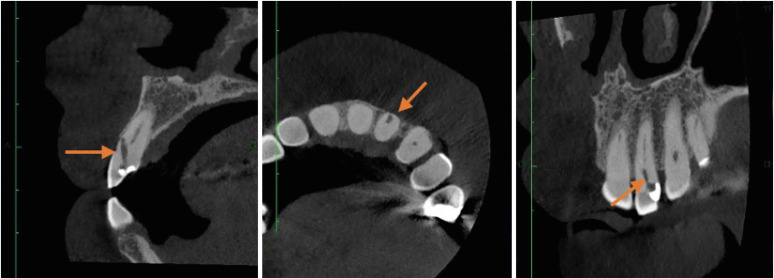 Procedural errors detected by cone beam tomography in cases with indication for retreatment: <i>in vivo</i> cross-sectional study.
