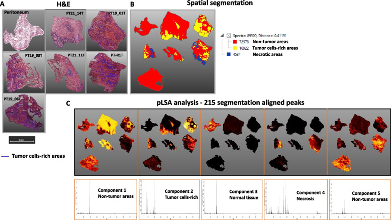 Sulfatide imaging identifies tumor cells in colorectal cancer peritoneal metastases.
