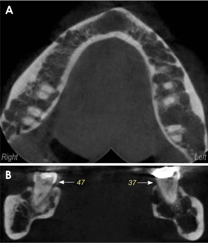 Beyond the mouth: Uncovering non-secretory multiple myeloma through oral symptoms.