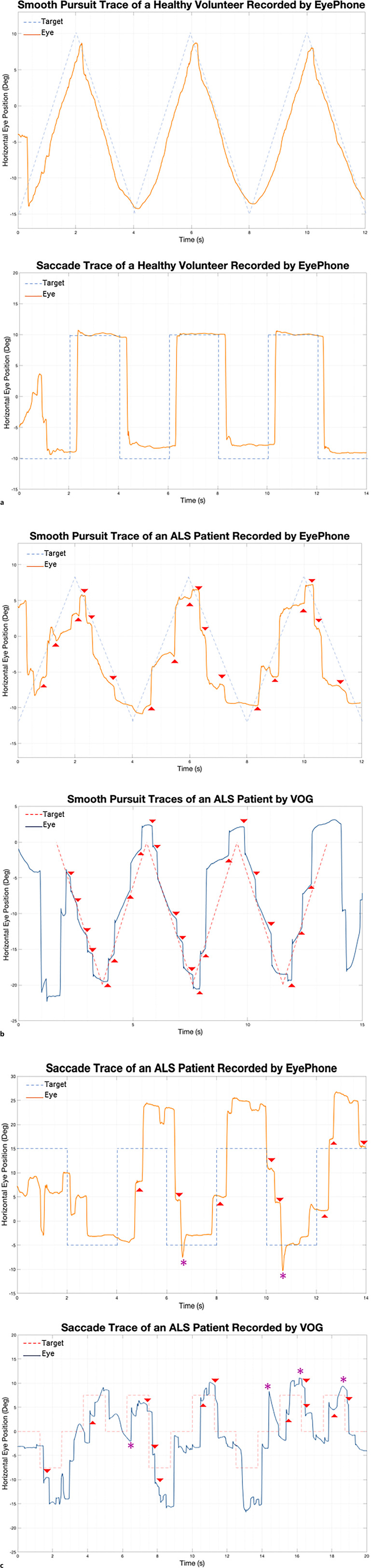 Self-Recording of Eye Movements in Amyotrophic Lateral Sclerosis Patients Using a Smartphone Eye-Tracking App.