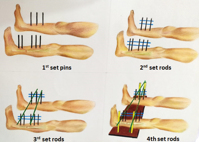 Fixation Techniques to Maintain Position for a Cross Leg Flap: Technical Tips and Algorithmic Approach.