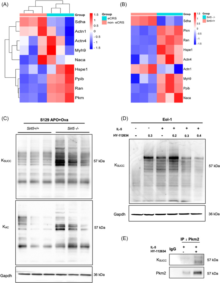 Sirt5 affects the metabolic remodeling of eosinophils by negatively regulating the level of succinylation modification of Pkm2 in eosinophilic chronic rhinosinusitis.