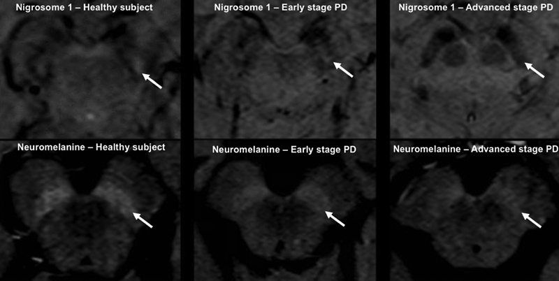 The clinical diagnosis of Parkinson's disease.