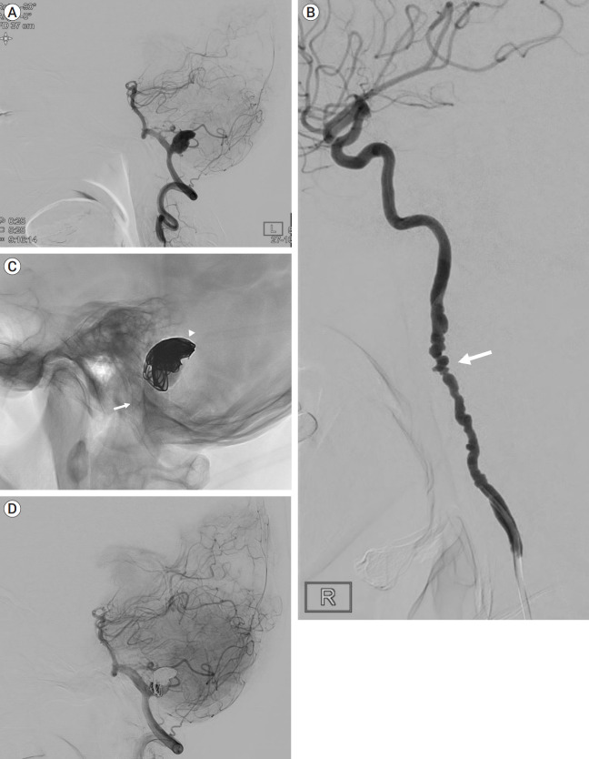 Delayed fatal rupture of vertebral artery after treated with flow-diverter in fibromuscular dysplasia patient: A case report and review of the literature.