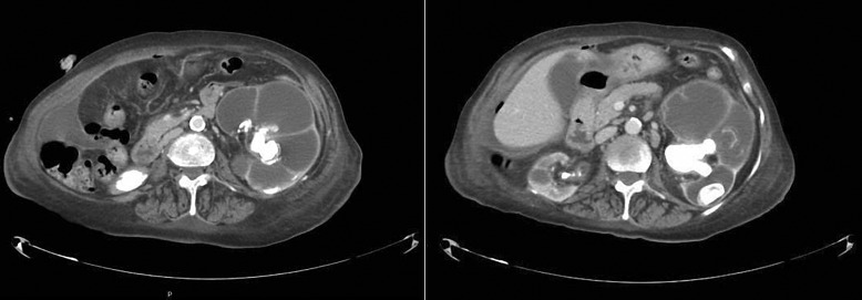 Xanthogranulomatous Pyelonephritis in Peritoneal Dialysis.