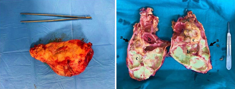 Xanthogranulomatous Pyelonephritis in Peritoneal Dialysis.