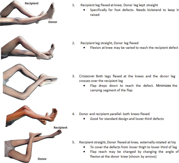 Fixation Techniques to Maintain Position for a Cross Leg Flap: Technical Tips and Algorithmic Approach.