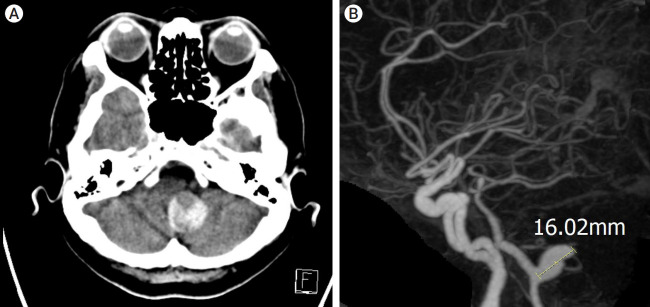 Delayed fatal rupture of vertebral artery after treated with flow-diverter in fibromuscular dysplasia patient: A case report and review of the literature.
