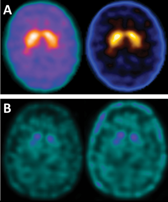 The clinical diagnosis of Parkinson's disease.