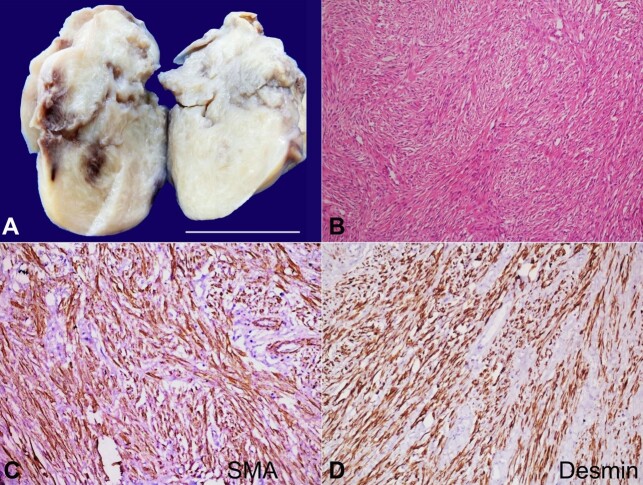 Leiomyoma of maxillary sinus.
