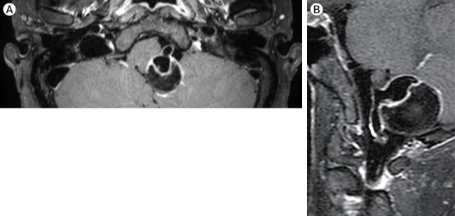 Delayed fatal rupture of vertebral artery after treated with flow-diverter in fibromuscular dysplasia patient: A case report and review of the literature.
