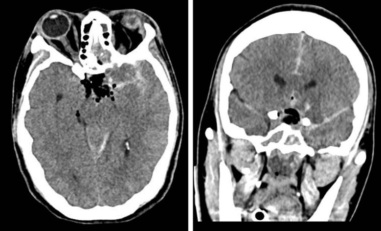 Unilateral caudate infarct following pituitary adenoma resection.