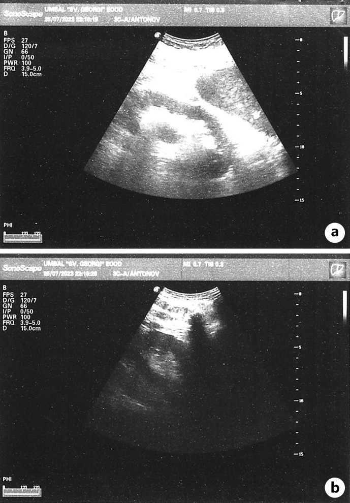 Emphysematous Pyelonephritis in a Patient on SGLT2 Inhibitor Therapy: A Rare Clinical Case Report.