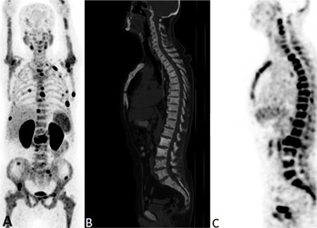 A Comprehensive Analysis of Volumetric <sup>68</sup>Ga-PSMA PET/CT Parameters, Clinical and Histopathologic Features: Evaluation of the Predictive Role.