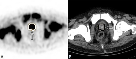 A Comprehensive Analysis of Volumetric <sup>68</sup>Ga-PSMA PET/CT Parameters, Clinical and Histopathologic Features: Evaluation of the Predictive Role.