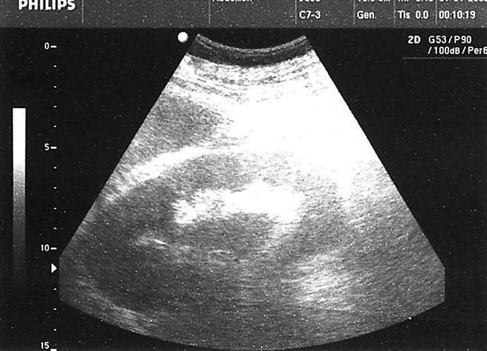 Emphysematous Pyelonephritis in a Patient on SGLT2 Inhibitor Therapy: A Rare Clinical Case Report.