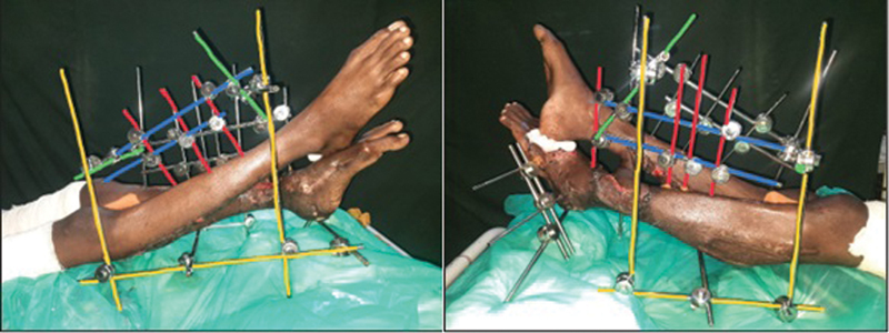 Fixation Techniques to Maintain Position for a Cross Leg Flap: Technical Tips and Algorithmic Approach.