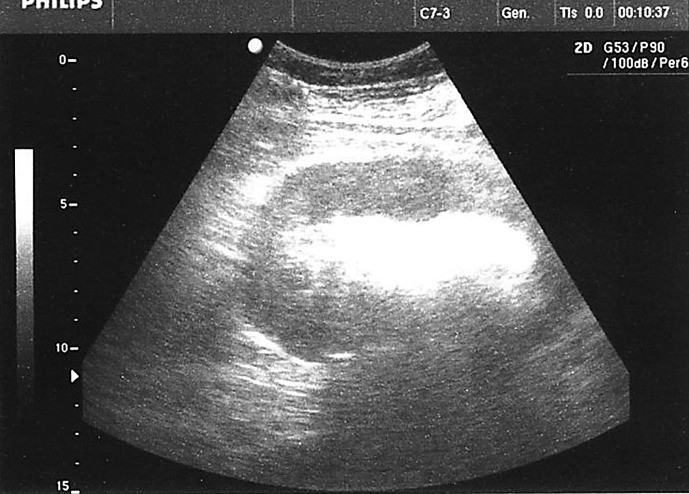 Emphysematous Pyelonephritis in a Patient on SGLT2 Inhibitor Therapy: A Rare Clinical Case Report.