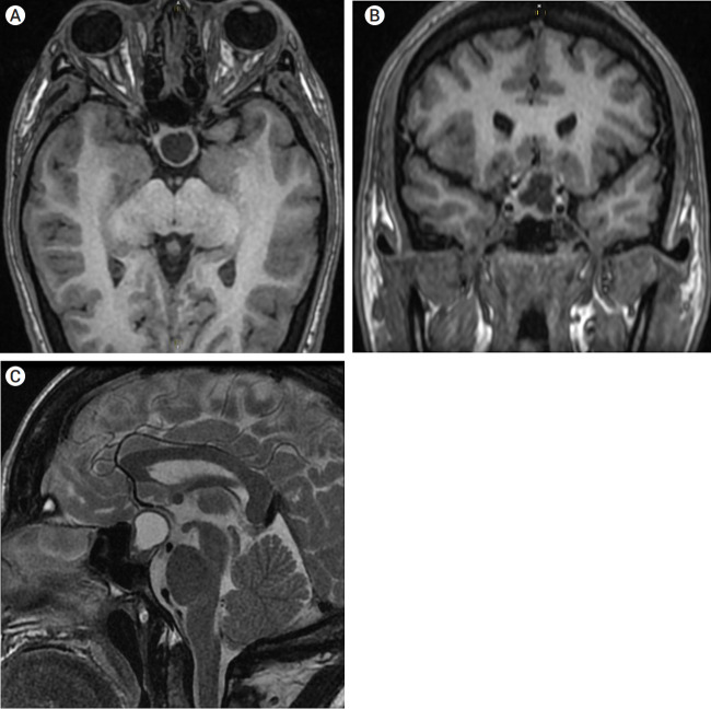 Unilateral caudate infarct following pituitary adenoma resection.