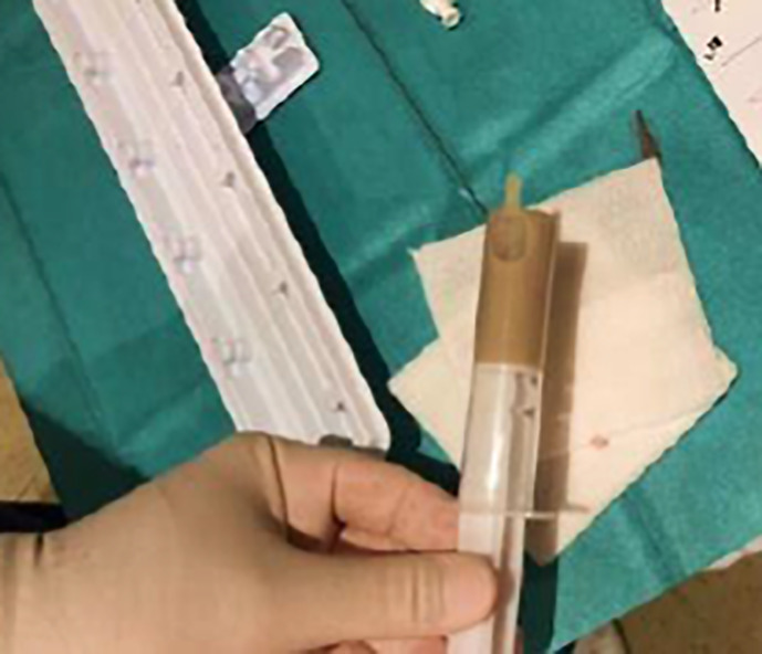 Xanthogranulomatous Pyelonephritis in Peritoneal Dialysis.