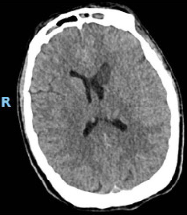 Unilateral caudate infarct following pituitary adenoma resection.