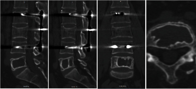 Solitary Bone Cyst in the Lumbar Spine: Case Report and Literature Review.
