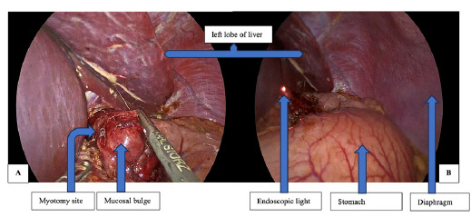 Achalasia Cardia: A Case Series.