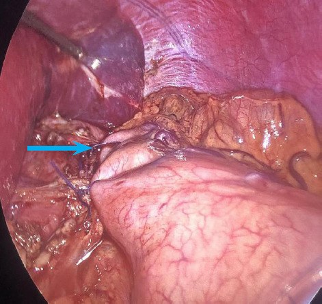 Achalasia Cardia: A Case Series.