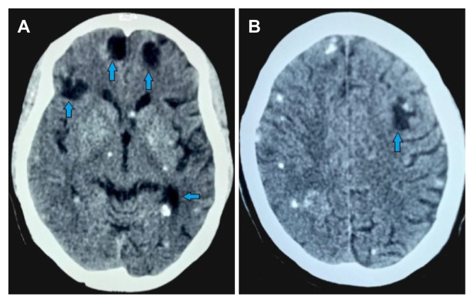 Unmasking a Hidden Culprit: Neurocysticercosis, an Overlooked Cause of Acquired Epilepsy.