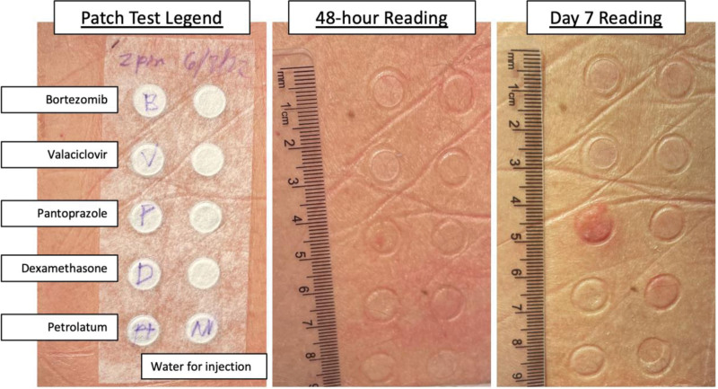 Strategic testing following toxic epidermal necrolysis allows reintroduction of chemotherapy in a patient with progressive myeloma.
