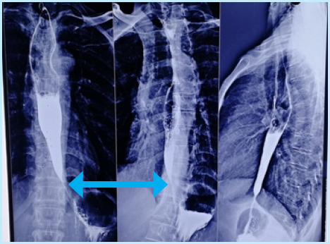 Achalasia Cardia: A Case Series.