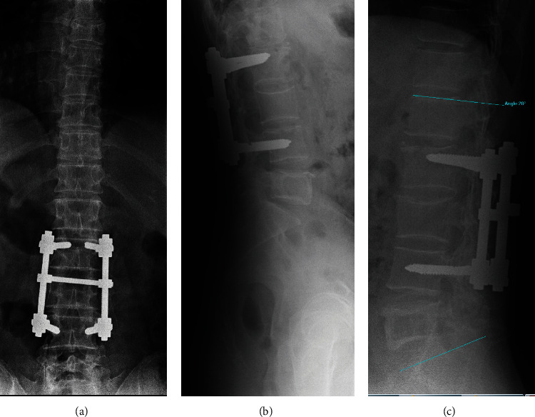 Solitary Bone Cyst in the Lumbar Spine: Case Report and Literature Review.