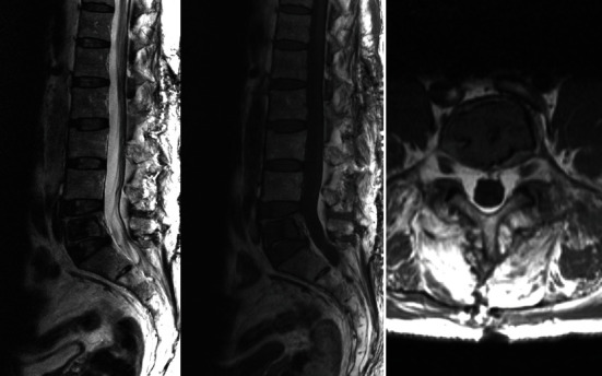 Solitary Bone Cyst in the Lumbar Spine: Case Report and Literature Review.
