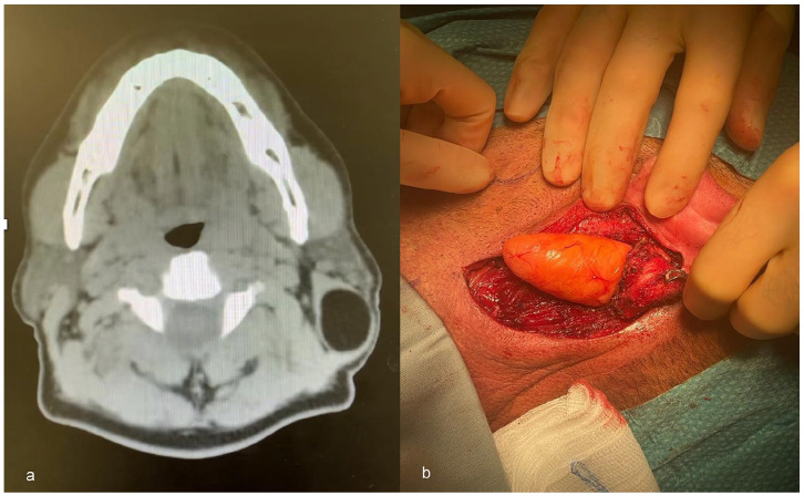 Intramuscular Lipoma of the Sternocleidomastoid Muscle: A Rare Entity Revisited.