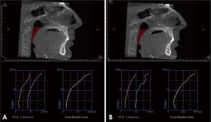 Correlation between cone-beam computed tomographic findings and the apnea-hypopnea index in obstructive sleep apnea patients: A cross-sectional study.