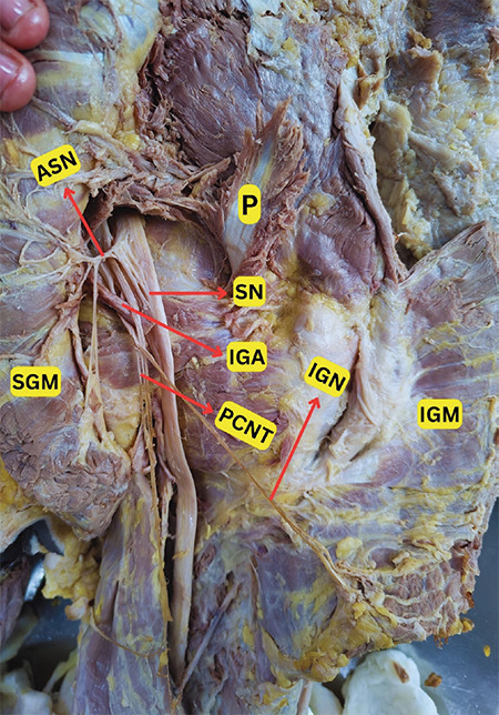 The Dual Innervation of the Gluteus Maximus Associated with Other Anatomical Variations of the Gluteal Region.